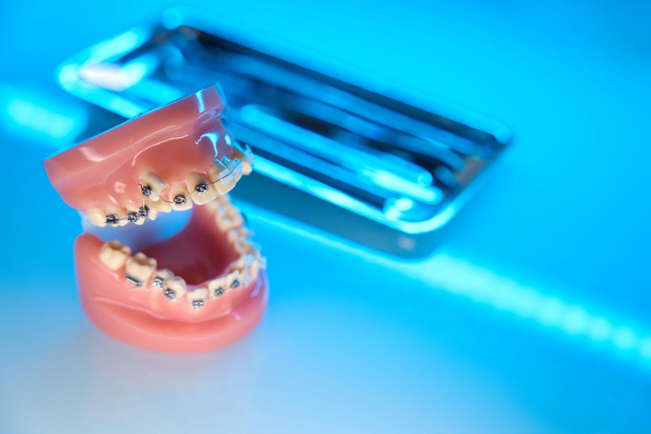 Jakie sa wskazania do zalozenia aparatu ortodontycznego